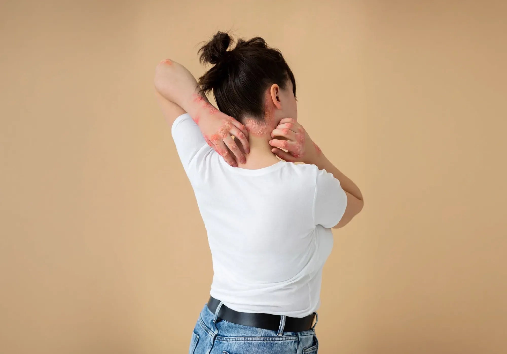 Начини за домашно лечение на екзема